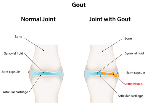 Gout- A form of Arthritis