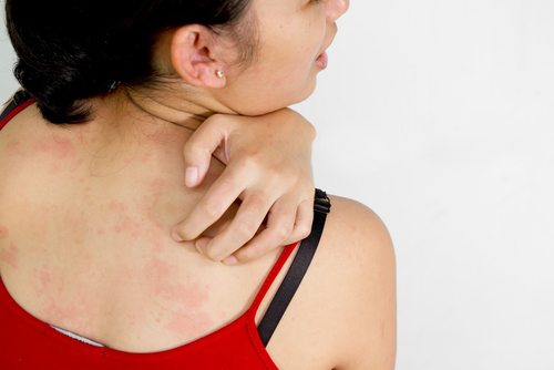 Detailing Hives- Symptoms, Causes, Treatment, and Prevention!