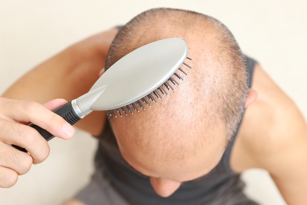 Prevent Hair Loss in Men