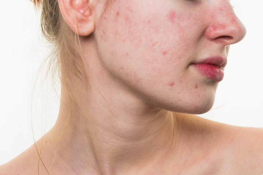 Bad Habits That Can Cause Pimples