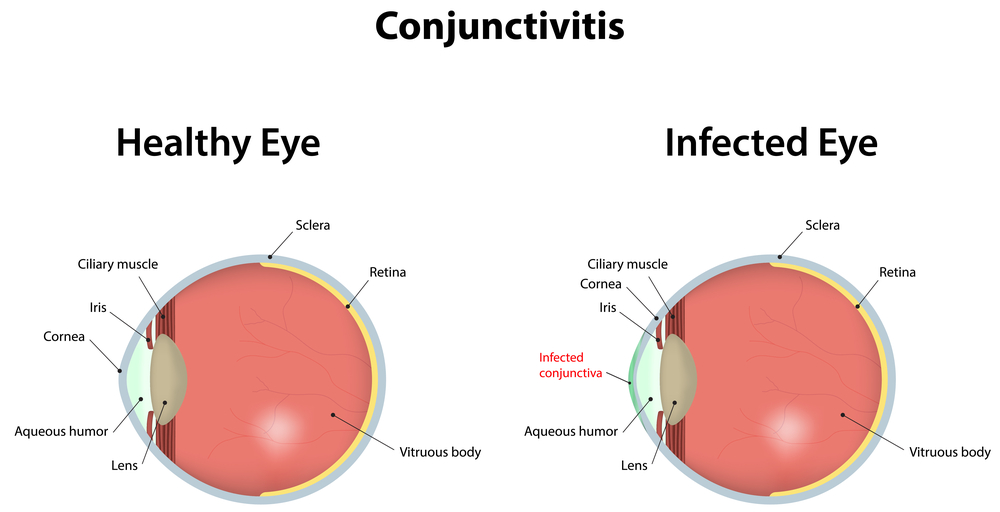 Coping with conjunctivitis