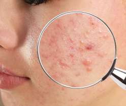 Magnifying glass showing acne