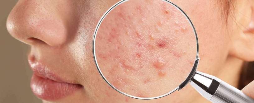 Magnifying glass showing acne