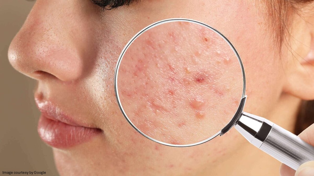 Magnifying glass showing acne