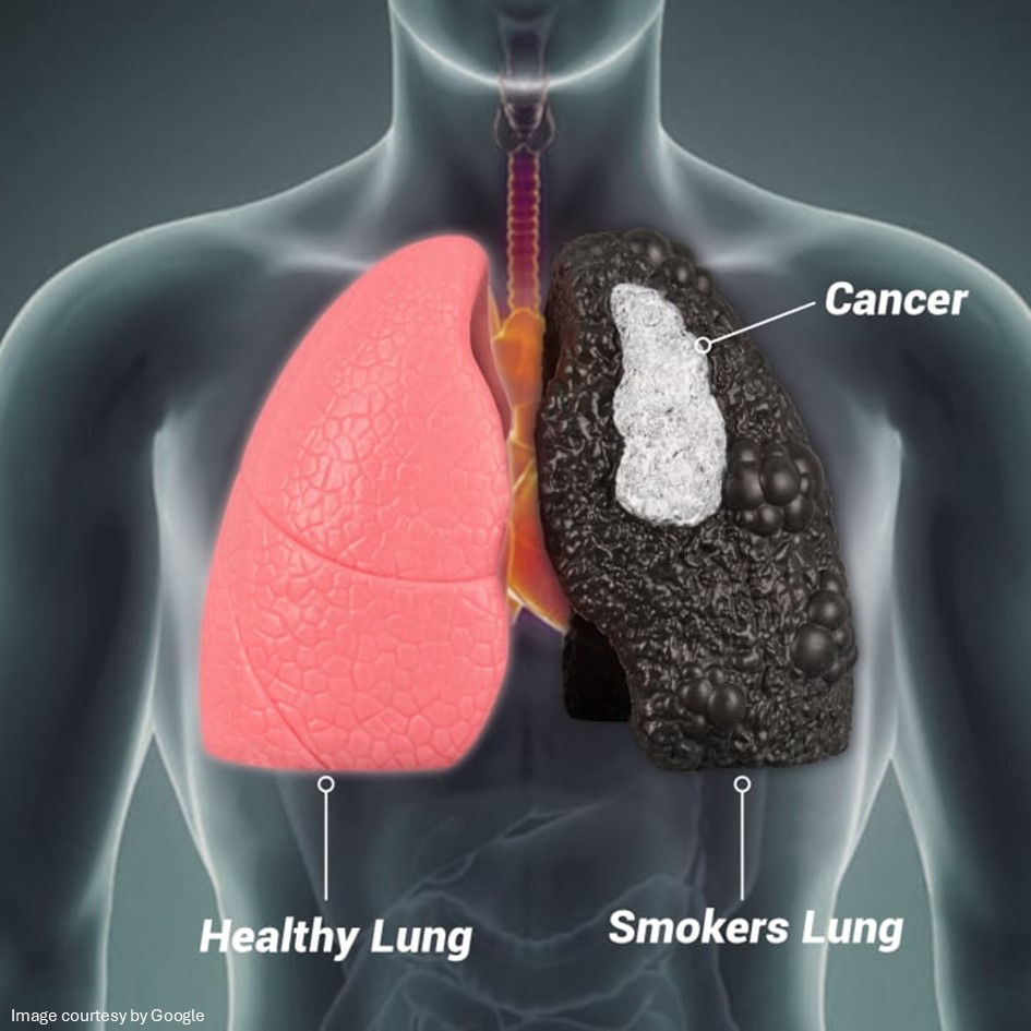 A body showing non smoker lung and smoker lung