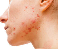 Smallpox Virus