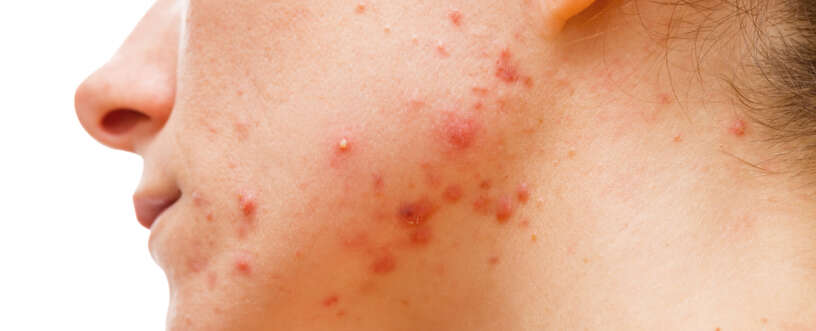 Smallpox Virus