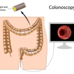 Colonoscopy
