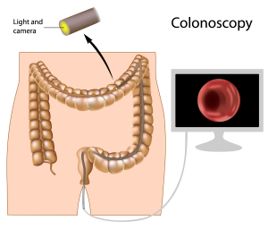 Colonoscopy