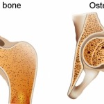 Osteoporosis