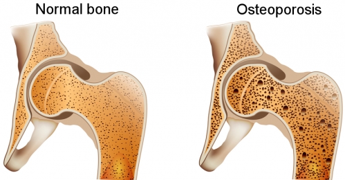 Osteoporosis