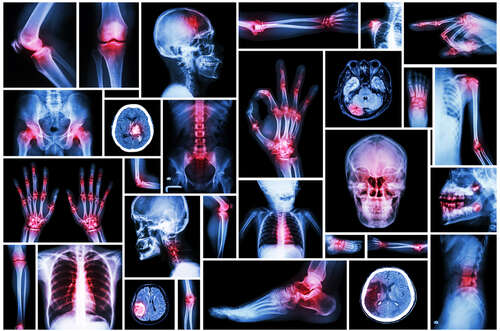 Arthritis