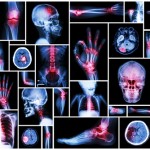 Arthritis