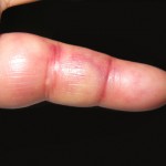 inflammation