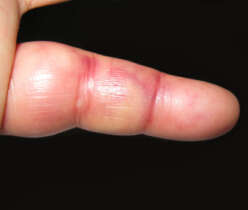 inflammation