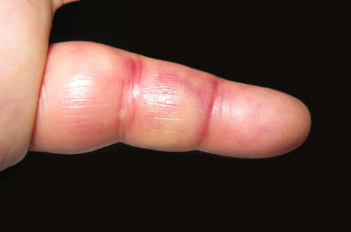 inflammation