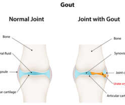 Gout- A form of Arthritis