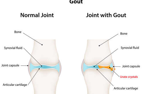 Gout- A form of Arthritis
