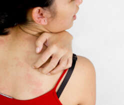 Detailing Hives- Symptoms, Causes, Treatment, and Prevention!