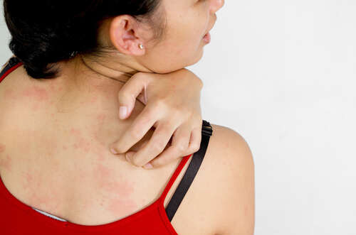 Detailing Hives- Symptoms, Causes, Treatment, and Prevention!