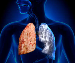 COPD and Asthma