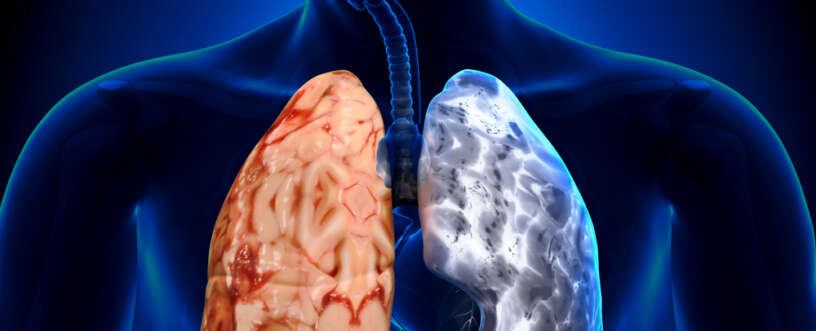 COPD and Asthma