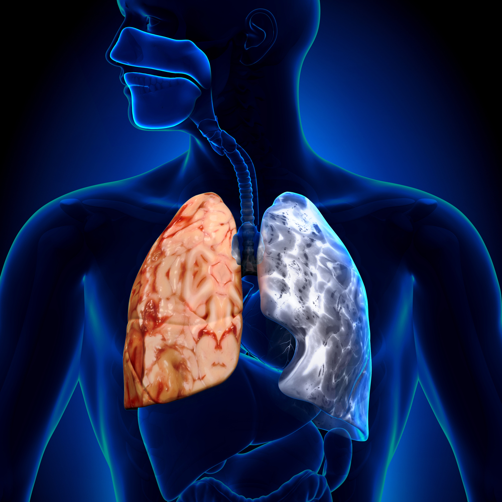 COPD and Asthma