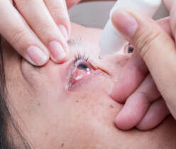 Keratitis