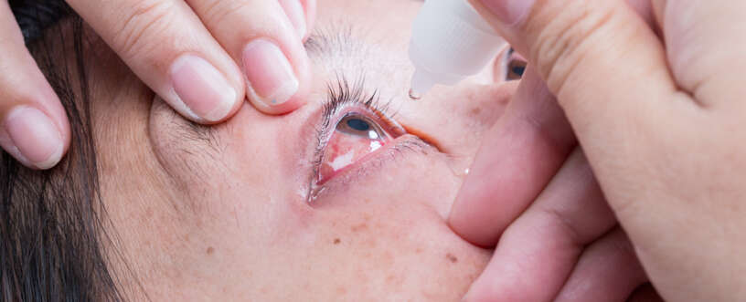 Keratitis