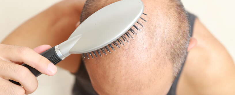 Prevent Hair Loss in Men