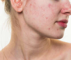 Bad Habits That Can Cause Pimples
