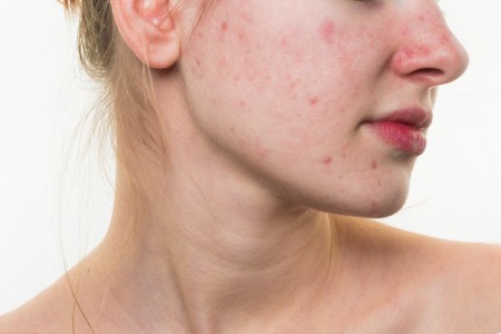 Bad Habits That Can Cause Pimples/Acne - ReliableRxPharmacy Blog