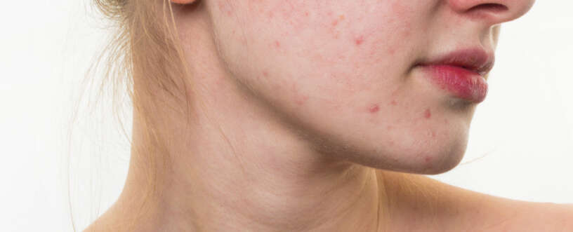 Bad Habits That Can Cause Pimples