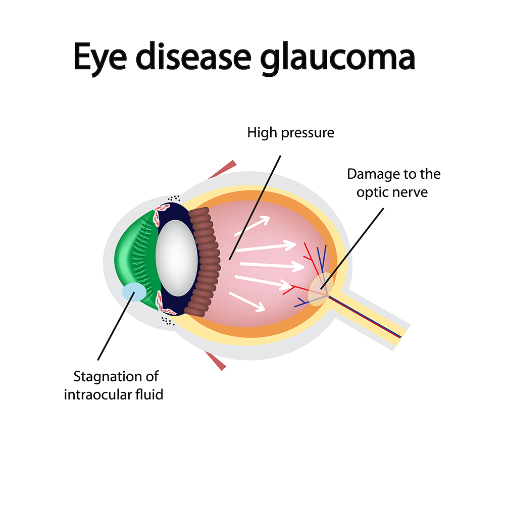 Glaucoma causes