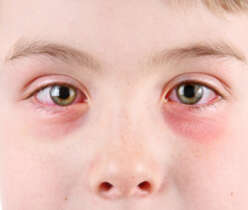 Watery Eyes Causes