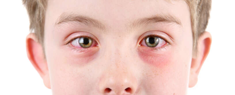 Watery Eyes Causes