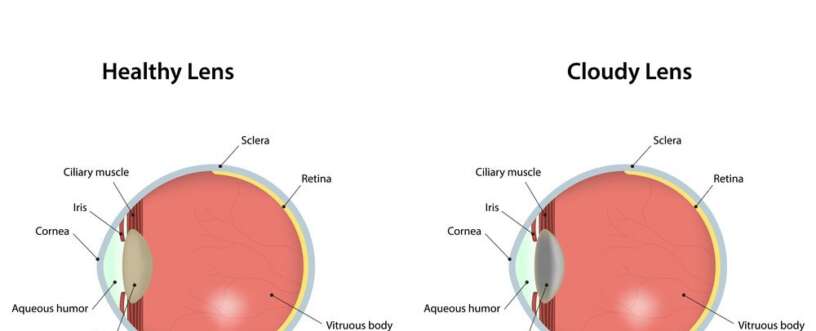 Cataract Clouding