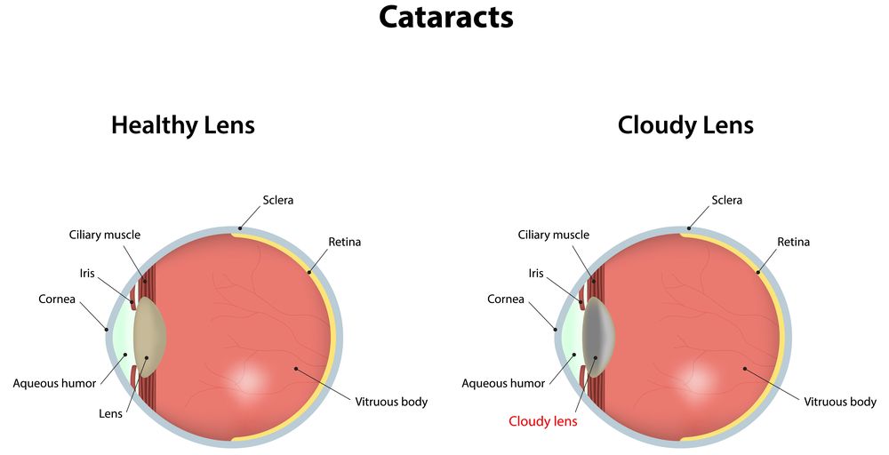Cataract Clouding