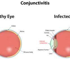 Coping with conjunctivitis