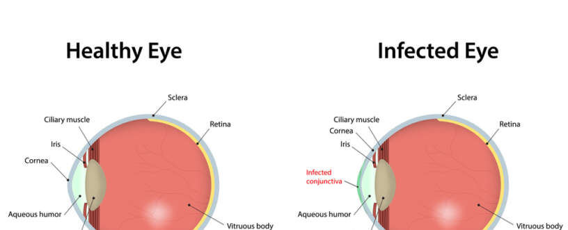 Coping with conjunctivitis