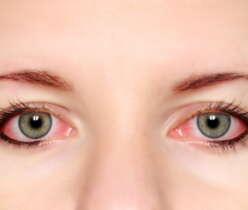 Allergic Conjunctivitis