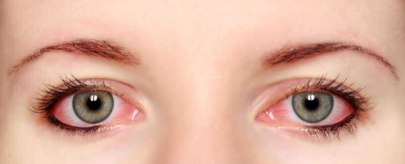 Allergic Conjunctivitis
