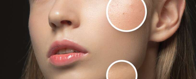 Acne