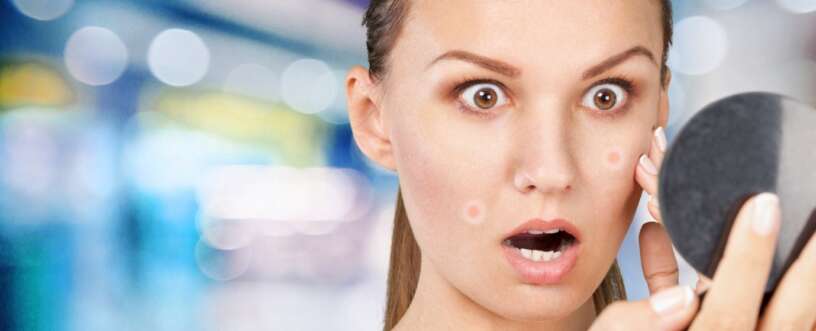 Large Pores and Acne