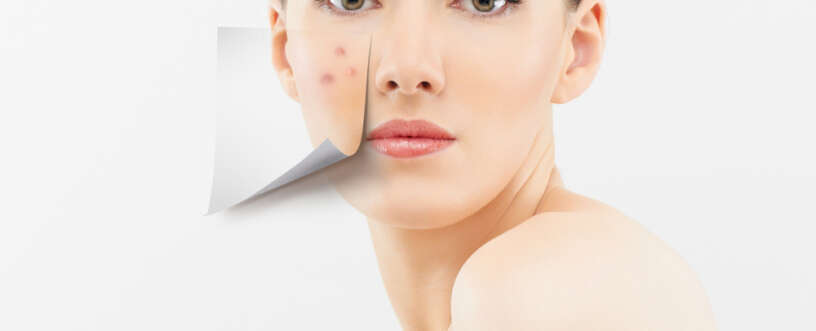 Deal with adult acne with utmost care