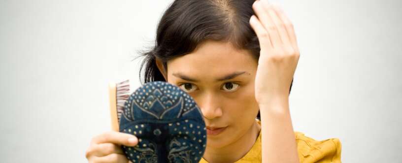 What is female pattern baldness?