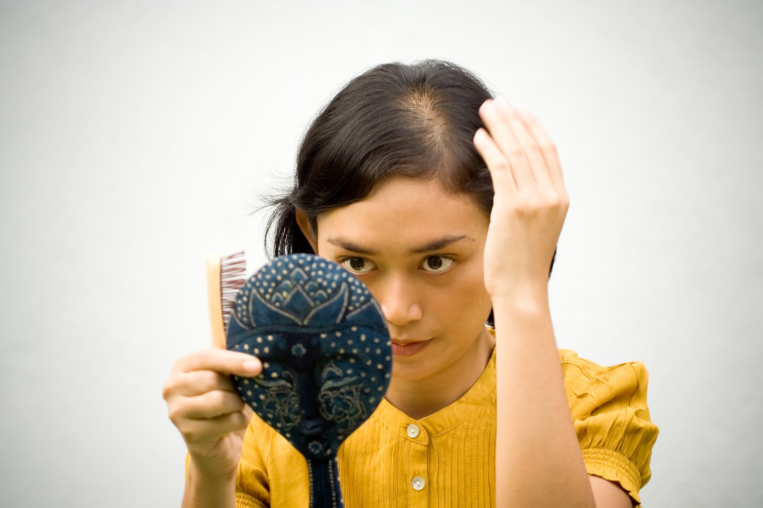 What is female pattern baldness?