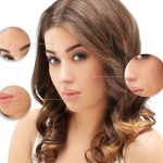 Acne Laser Treatments