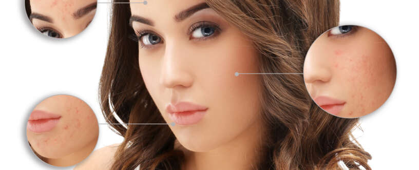 Acne Laser Treatments