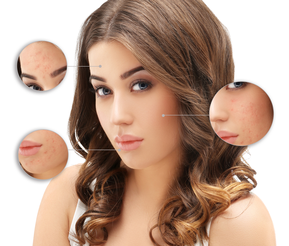 Acne Laser Treatments